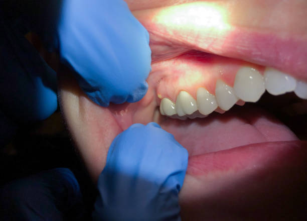Best Emergency Denture Repair in Deschutes River Woods, OR